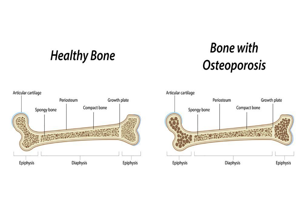 Arthritis Osteoporosis Center of Biology Diagrams